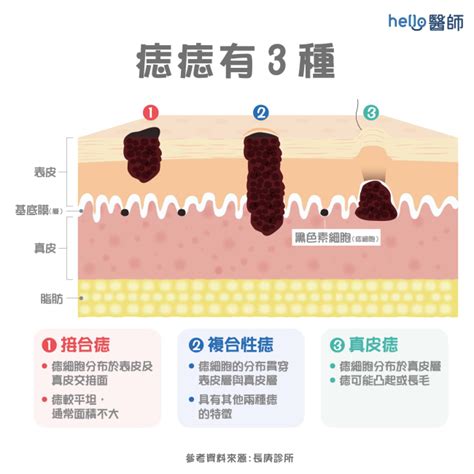 多痣的人|痣形成的原因？痣長毛、痣變多變大是痣病變？5招判。